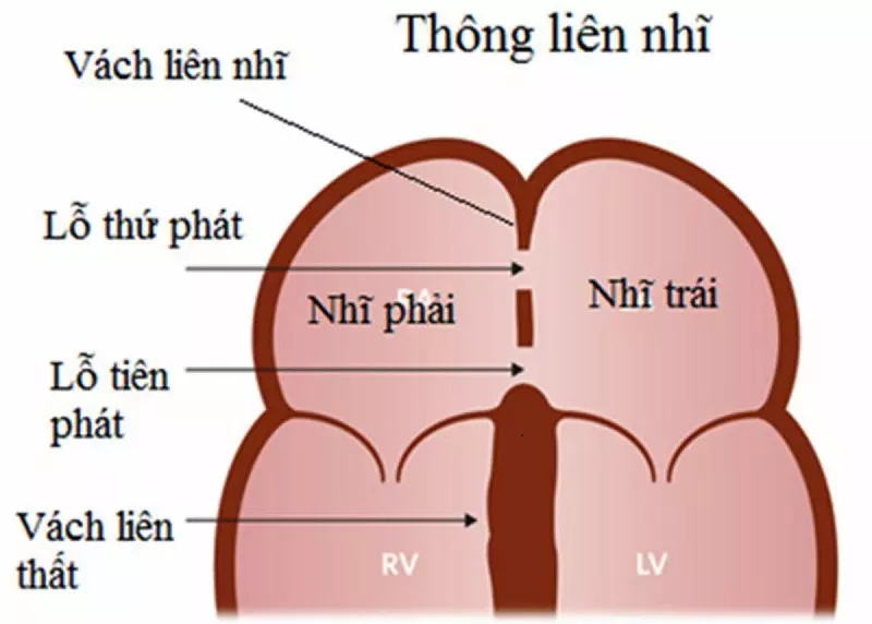 Thông liên nhĩ là tình trạng xuất hiện lỗ hở ở vách liên nhĩ.webp